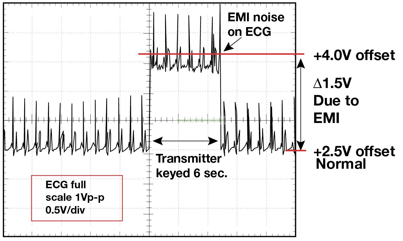 图 1    1.5 英尺以外的发射器（f = 470 MHz, P= 0.5W）开启和关闭时 ECG 诊断设备的心脏检查结果