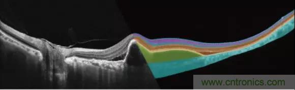 国际巨头布局全球眼科AI，中国智造能否打破OCT市场被外商垄断局面？