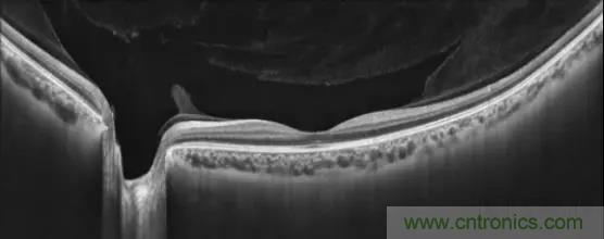 国际巨头布局全球眼科AI，中国智造能否打破OCT市场被外商垄断局面？