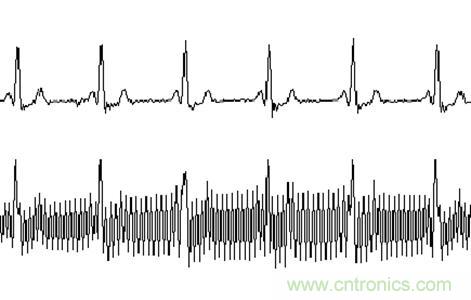 采用MSP430设计的12位心电(ECG)放大器